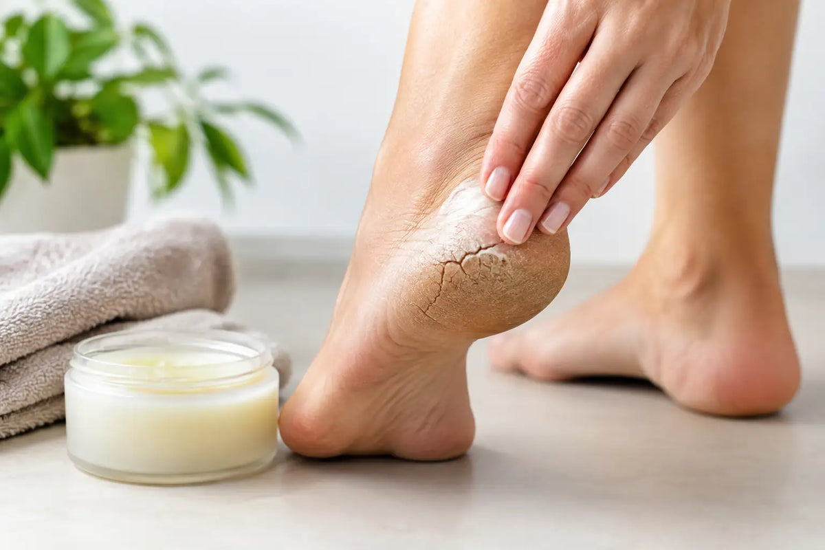 A Cracked Heels Balm Story Worth Telling