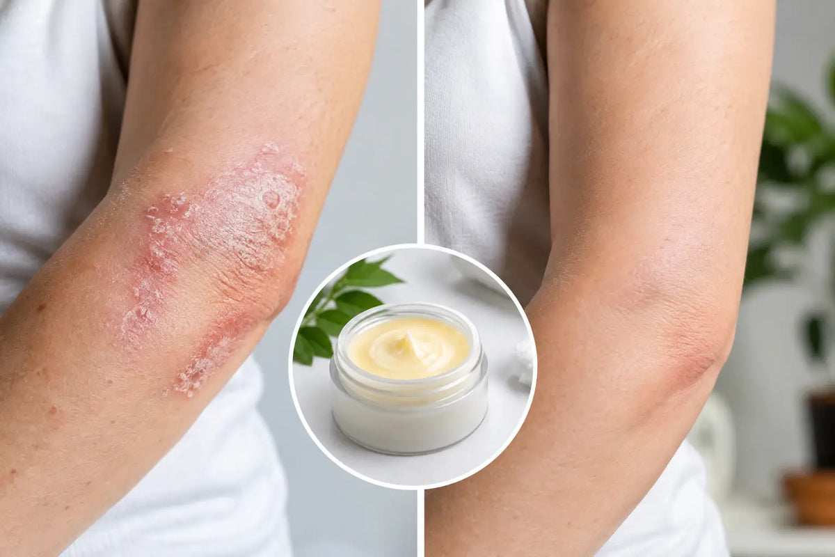 Psoriasis Balm Before After Example: What to Notice