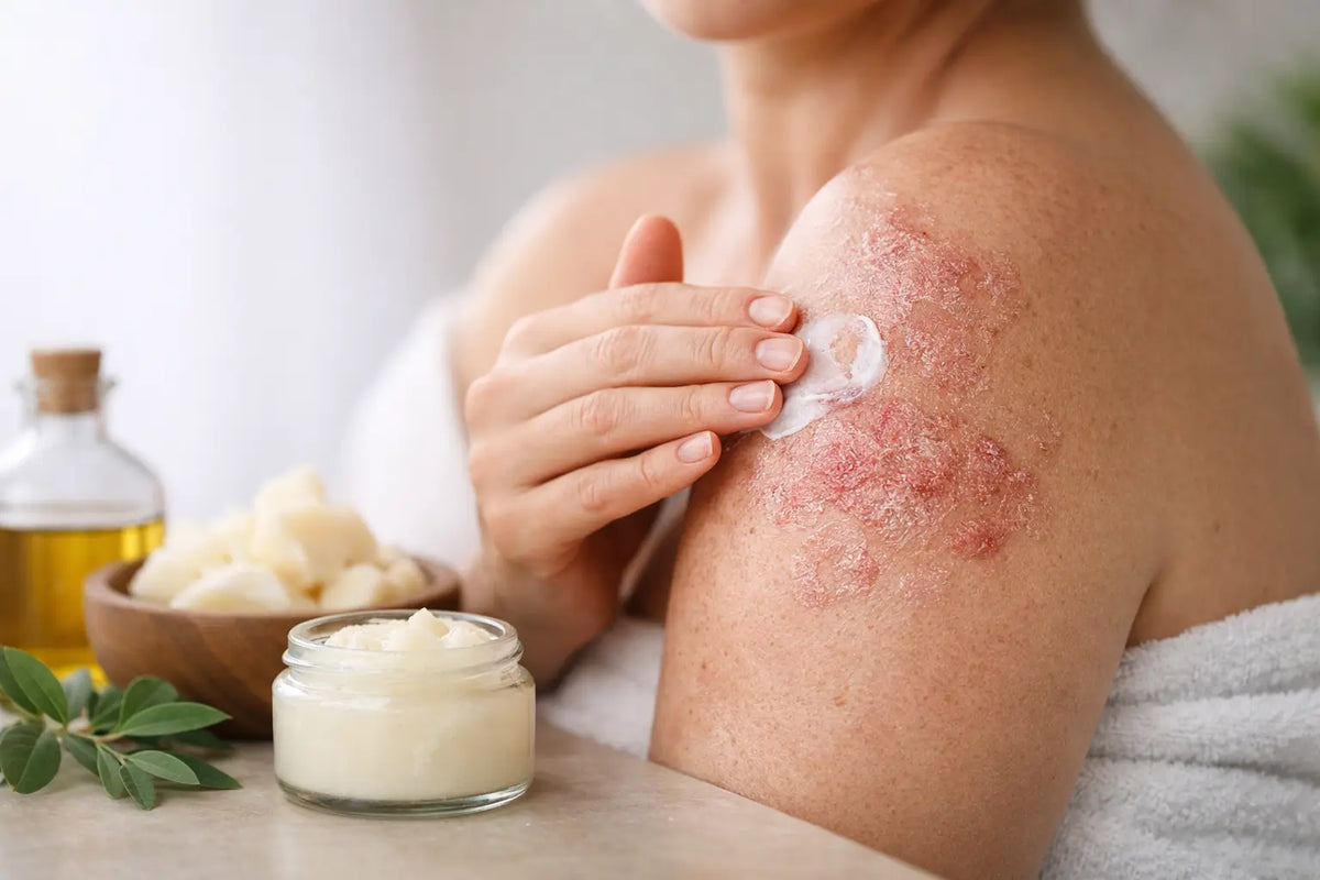 Can Tallow Help Psoriasis Skin Feel Calmer?